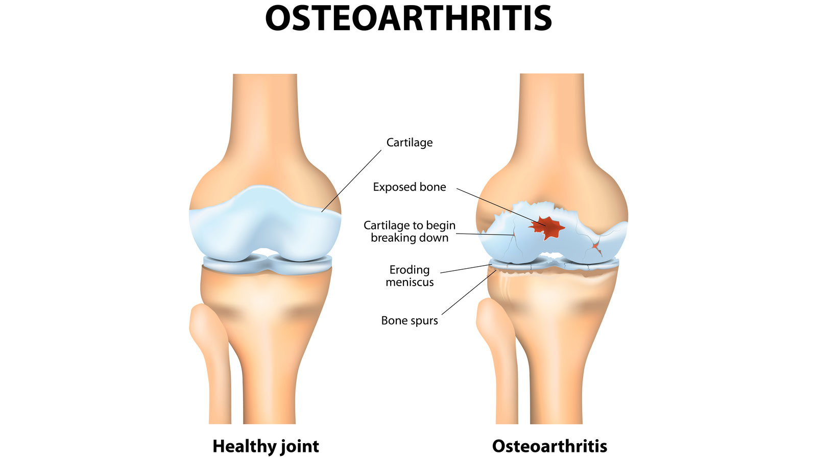 Osteoarthritis