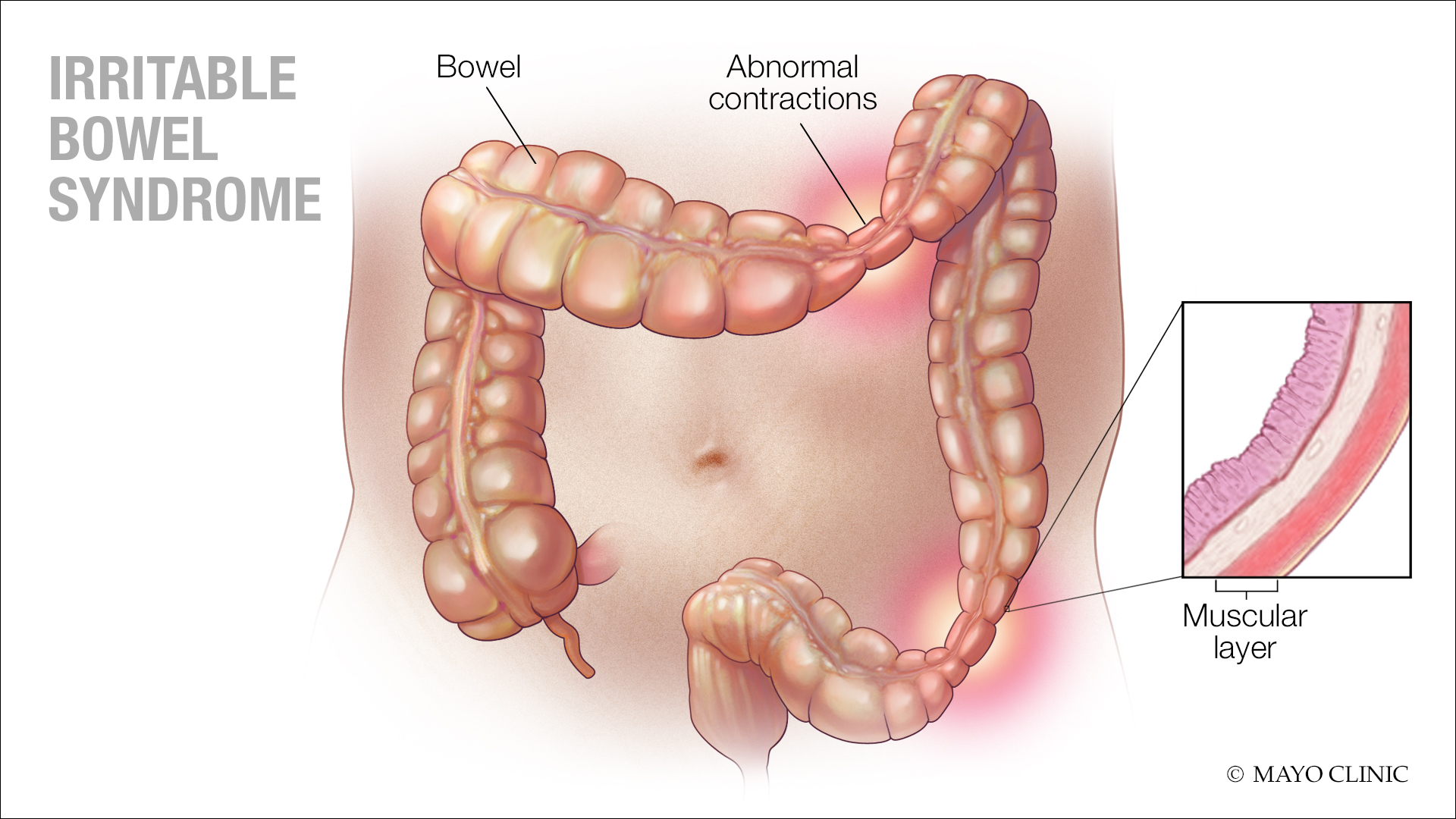 Irritable Bowel Syndrome (Ibs)