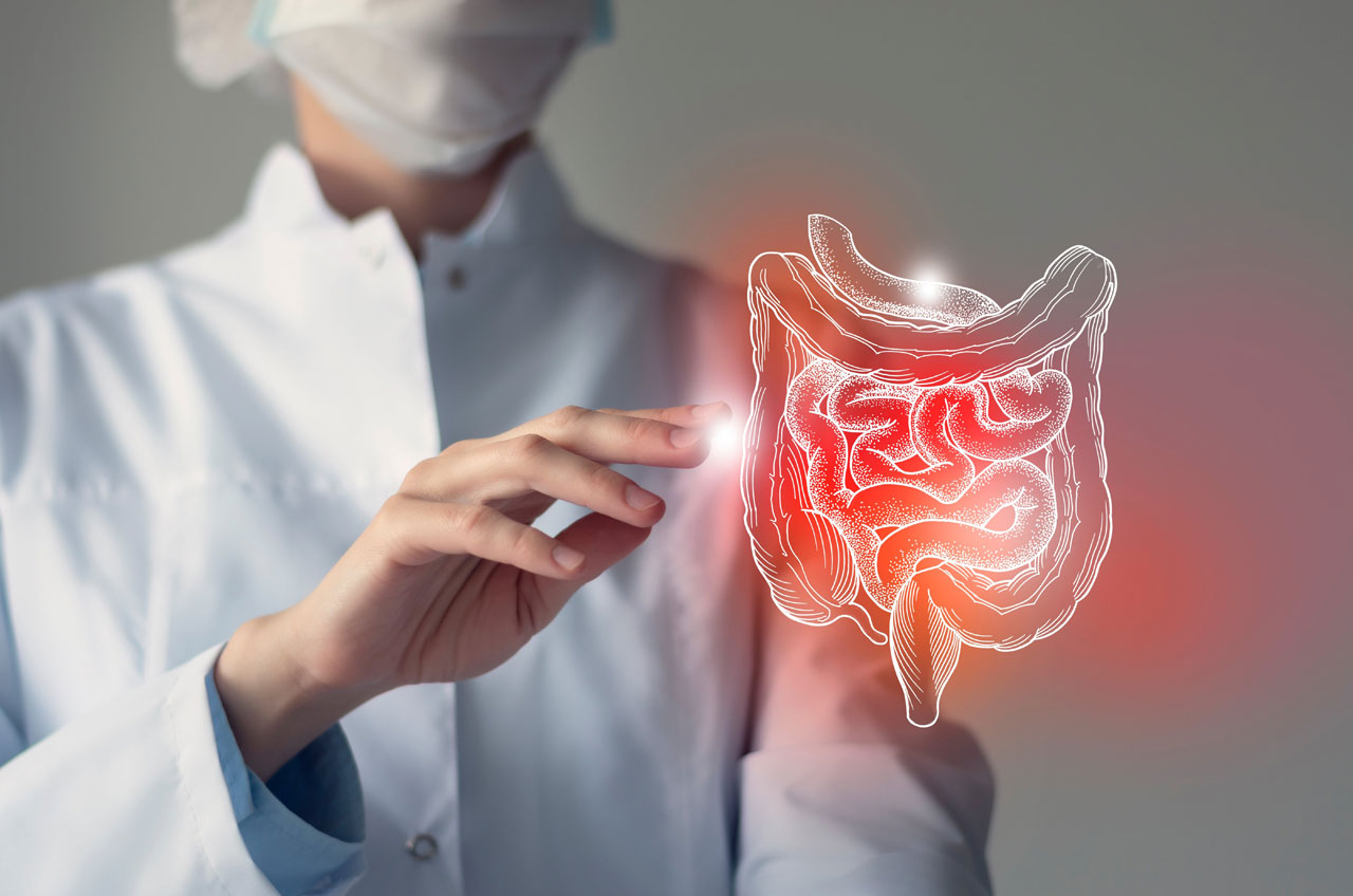 Ulcerative Colitis